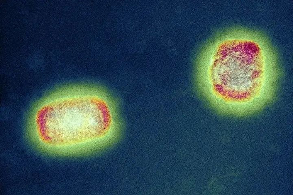 Antijen Hızlı Testi: Dünya tarafından ihmal edilen Monkeypox, bir sonraki süper bulaşıcı hastalık olacak mı?
